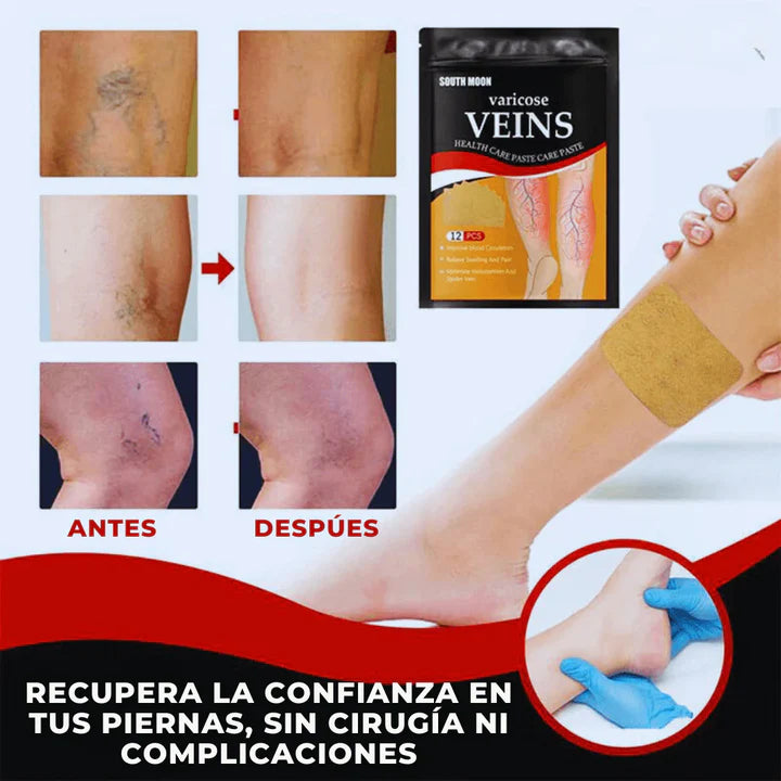 PARCHES PARA EL TRATAMIENTO DE VENAS VARICOSAS/VARICES (48 UNIDADES) + ENVIO GRATIS 💝